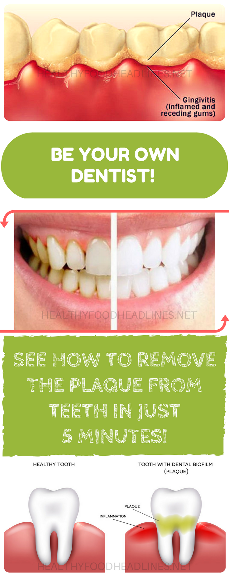 BE-YOUR-OWN-DENTIST-SEE-HOW-TO-REMOVE-THE-PLAQUE-FROM-TEETH-IN-JUST-5-MINUTES (1)