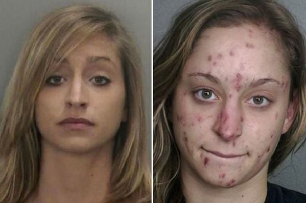 skin disorders from drug abuse - before and after example