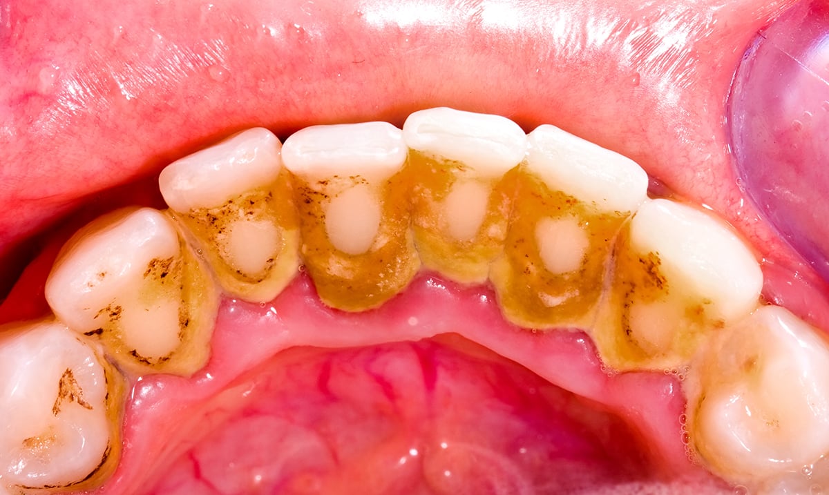 saliva compostion and calculus buildup