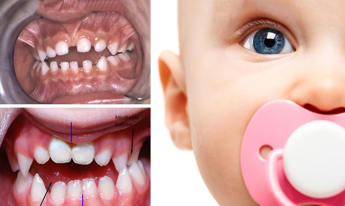 9 Harmful Side Effects of Baby Pacifiers