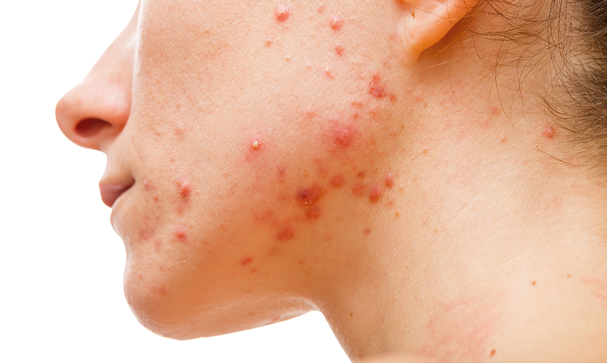 Research Reveals A Vaccine for Acne May Be Just Around the Corner