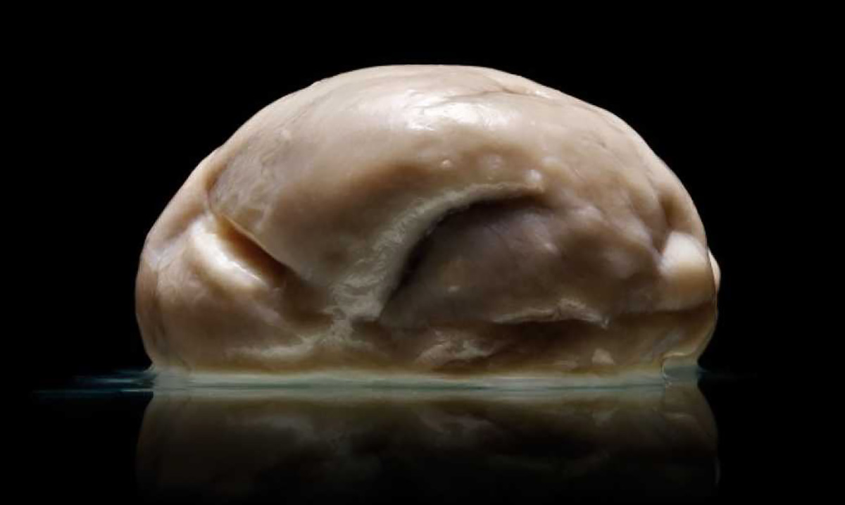 Strange Human Brain With No Wrinkles Found, Baffling People Everywhere!