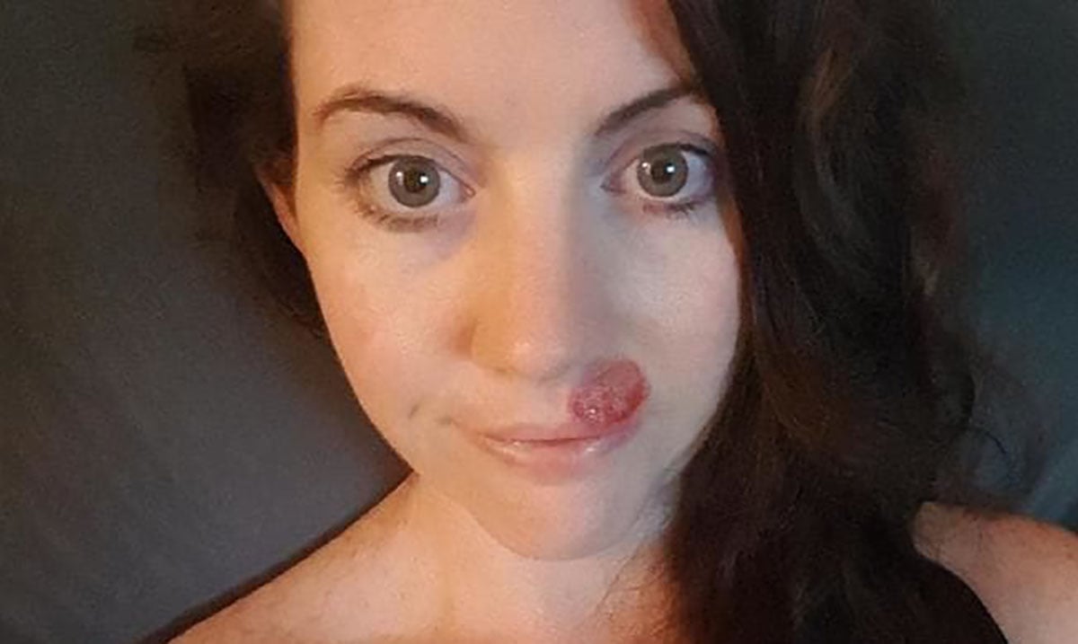 Woman’s Stark Warning After Finding Out That the ‘Innocent Pimple’ Was Deadly Cancer