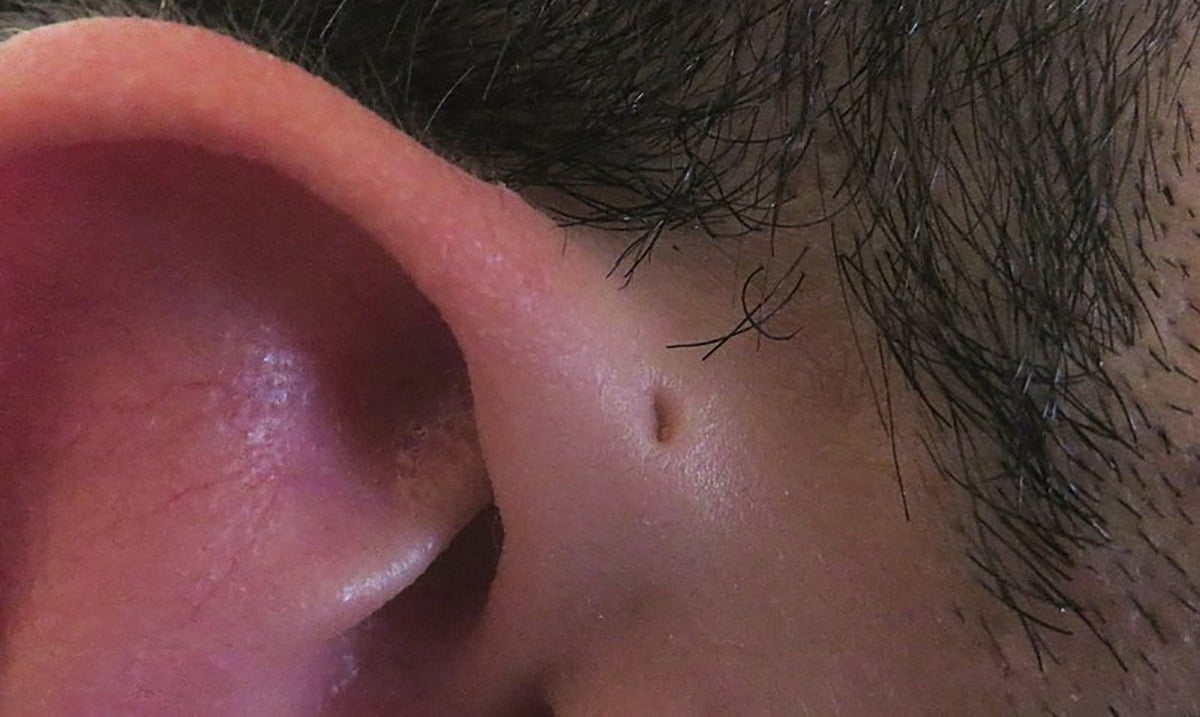 Were You Born With Tiny Holes By Your Ears? This Is What It Means!
