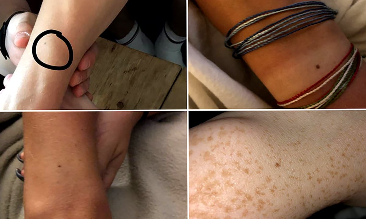 The Surprising Reason Why Most People Have A Freckle On Their Wrist
