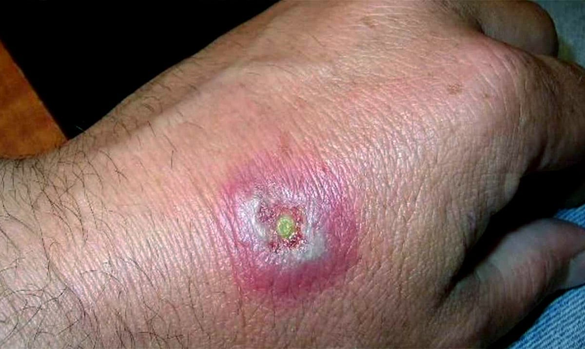 Scientists Warn Flesh Eating Bacteria Could Be Spread By Mosquitoes