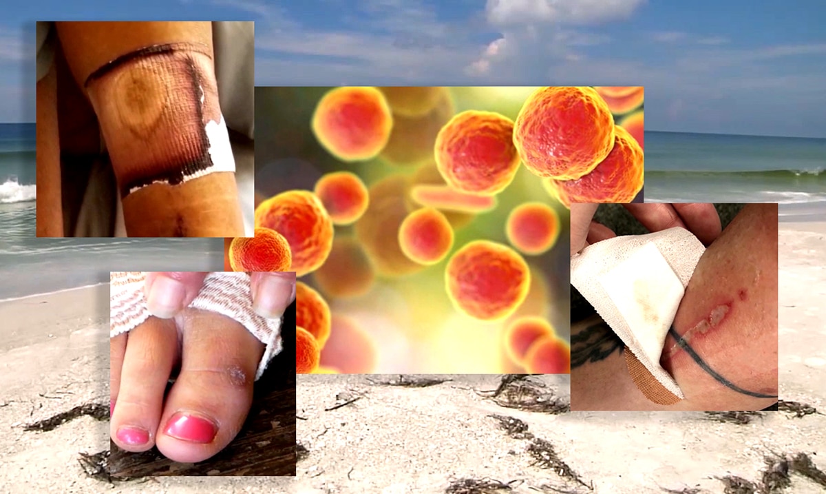 Florida Flesh-Eating Bacteria Infects Two And Kills One