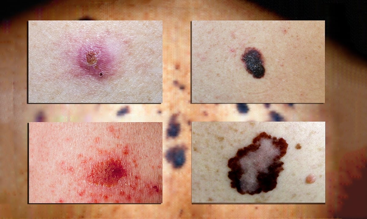 Can You Spot Deadly Skin Cancer? It’s Not Always ‘Just A Mole’