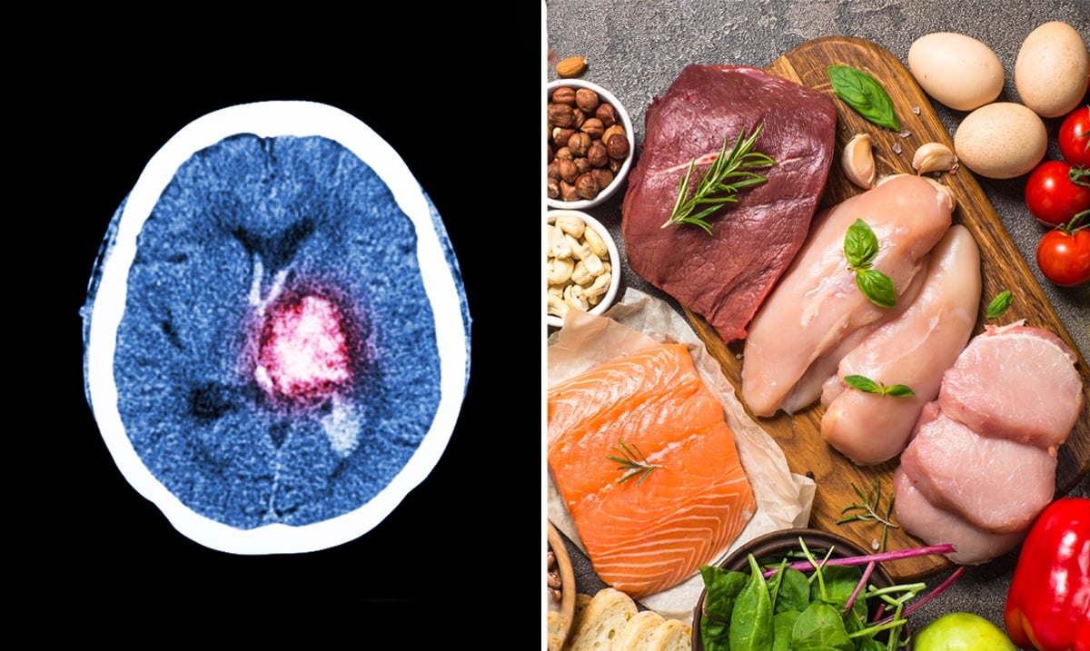 Study Finds Link Between Keto Diet And Brain Tumor Growth