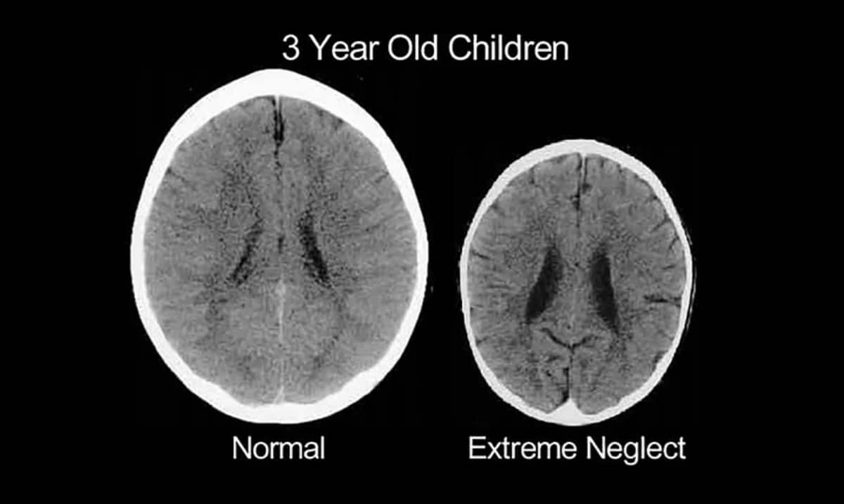 Brain Scans Show Horrific Impact Of Emotional Abuse On Developing Toddler Brains