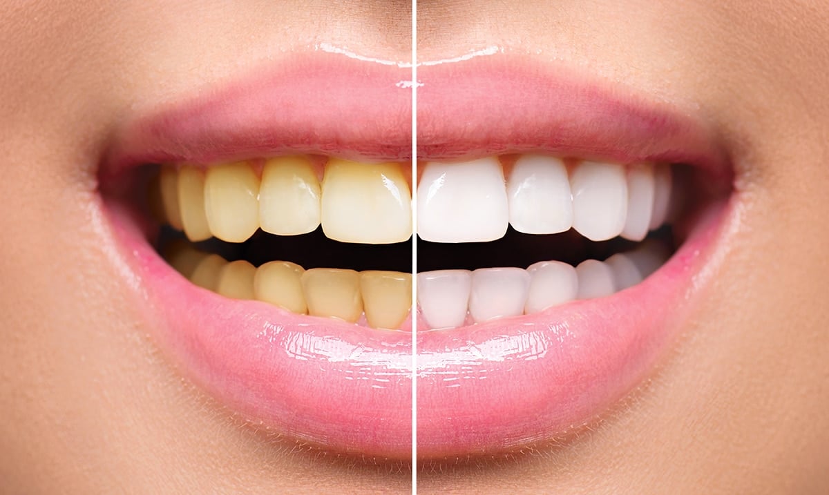 9 Ways To Naturally Whiten Yellow Teeth