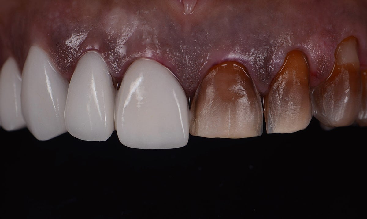 New Synthetic Tooth Enamel That Is Stronger Than Real Teeth