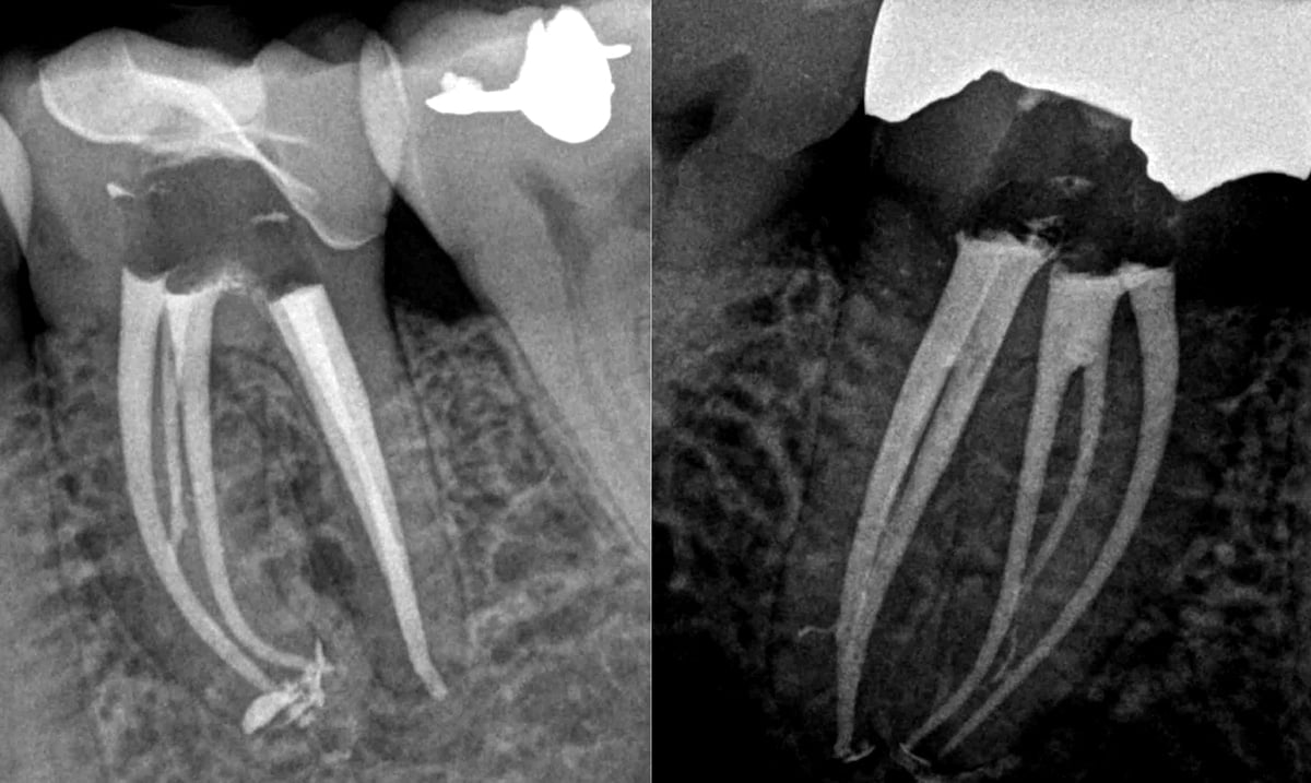 Dentist Explains Why He Refused to Perform Root Canals For 20 Years