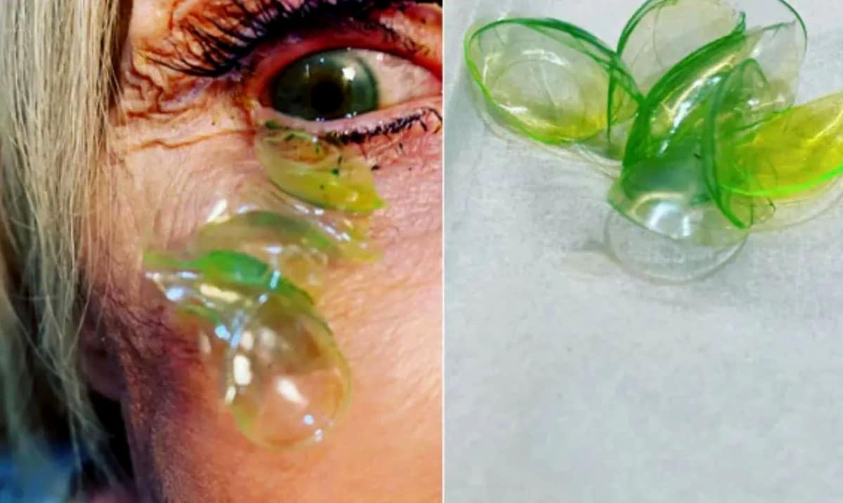 Doctor Removes 23 Contact Lenses From Woman’s Eye