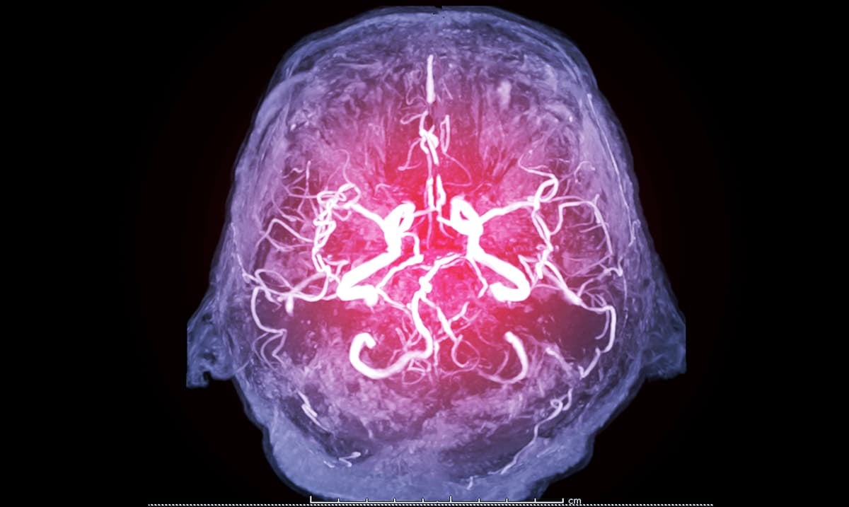 Strokes Are On The Rise In Young People – This Is Why